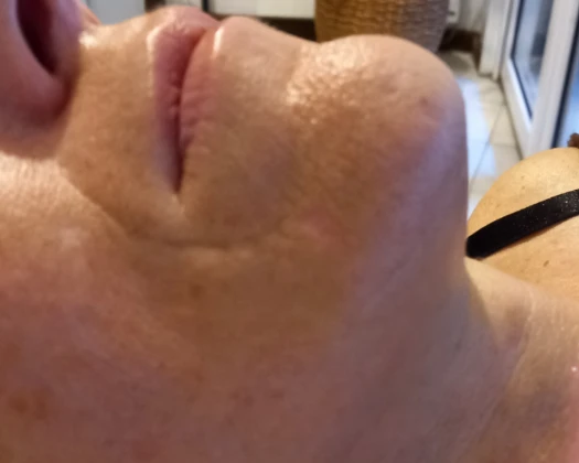 rajeunissement Tarbes, rajeunissement Hautes-Pyrénées, rajeunissement 65